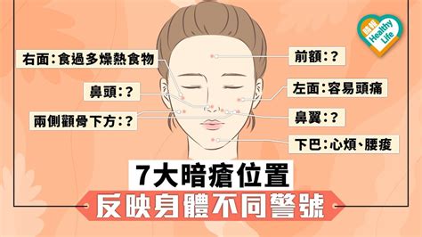 左邊面暗瘡|【暗瘡位置】不同代表什麼？中醫教如何處理及預防